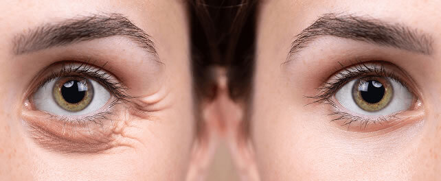 Resultado de Blefaroplastia - Cirurgia de Pálpebras realizada pela Dra. Michele Setúbal mostrando rejuvenescimento do olhar